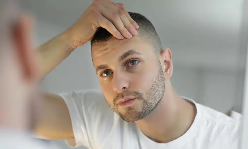 Qu'est-ce qu'une greffe de cheveux FUE ?