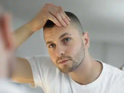 Qu'est-ce qu'une greffe de cheveux FUE ?