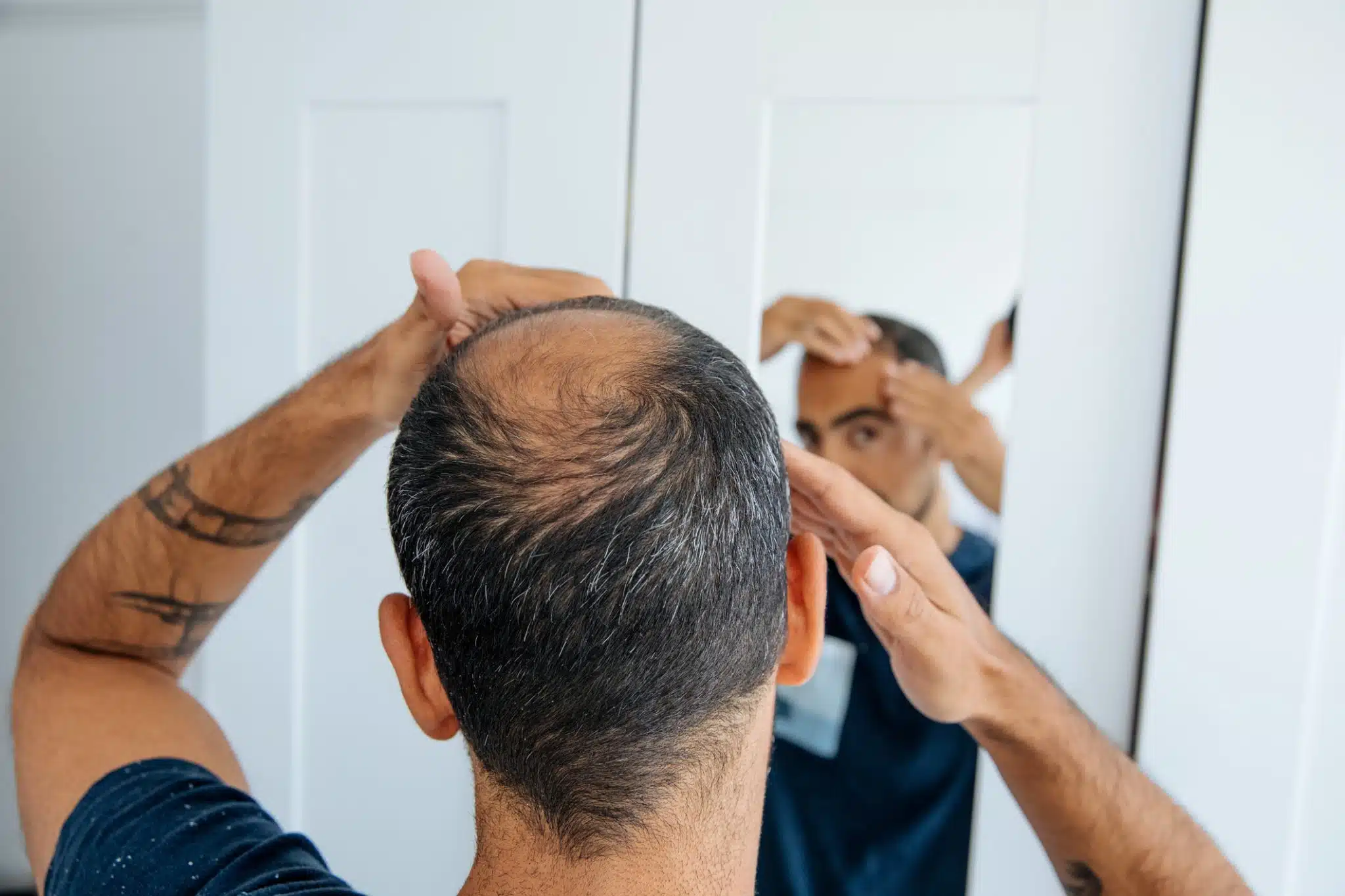 Qu'est-ce qu'une greffe de cheveux FUE ? 